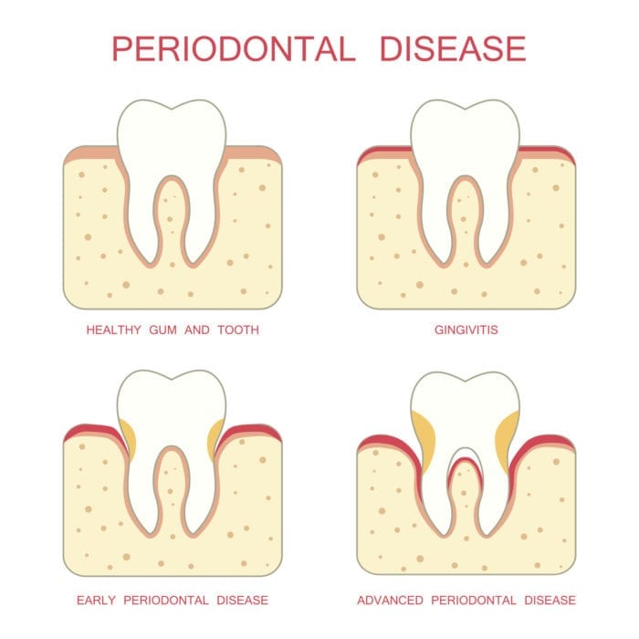 periodontal therapy in Strongsville Ohio