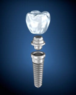 affordable dental implants in Strongsville Ohio