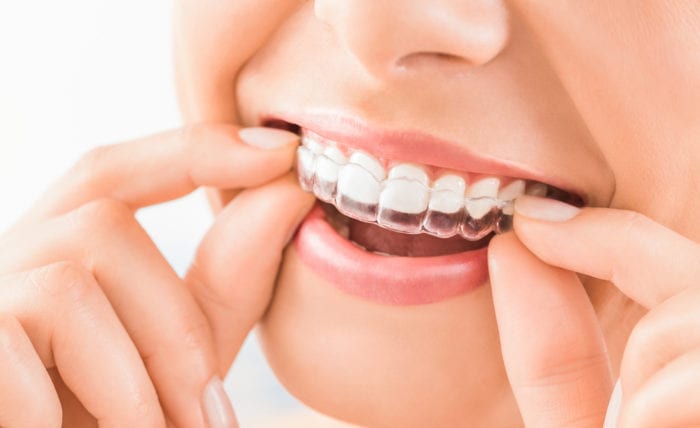 Invisalign clear aligners in Strongsville Ohio