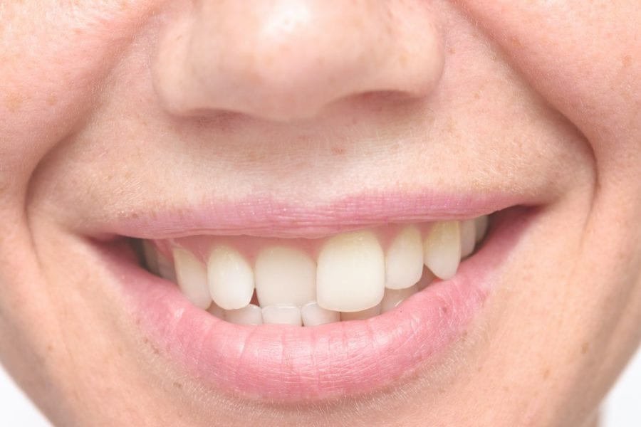 Why Straighten Crooked Teeth? Strongsville, OH Cosmetic Dentistry