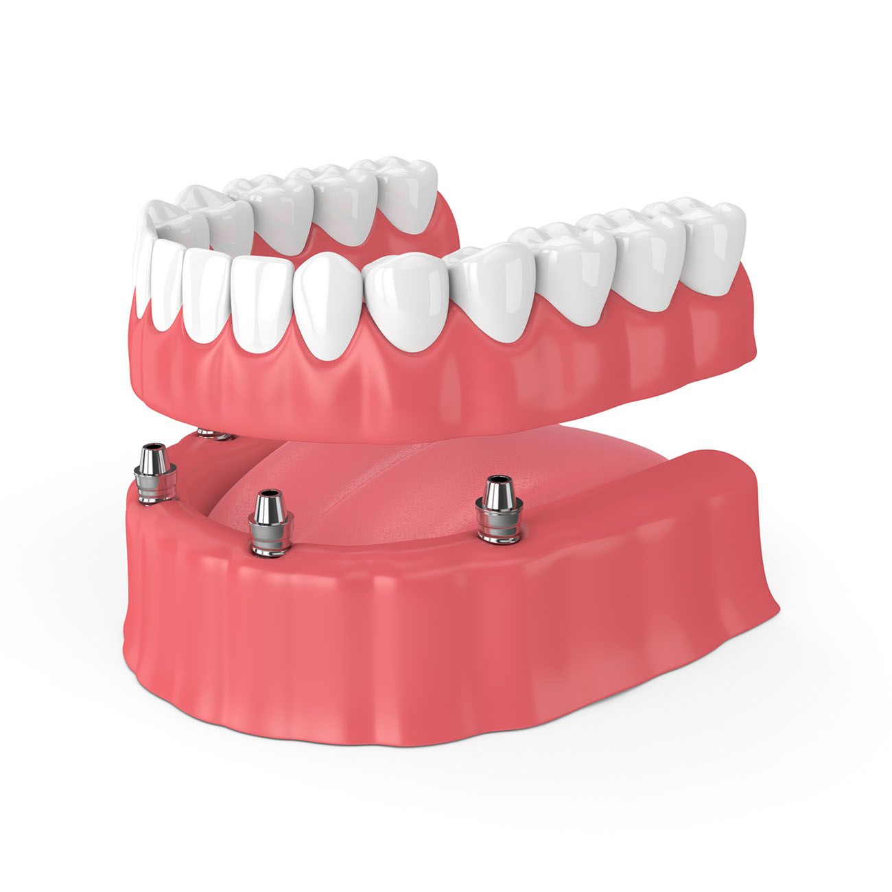 implant dentures dentist strongsville oh
