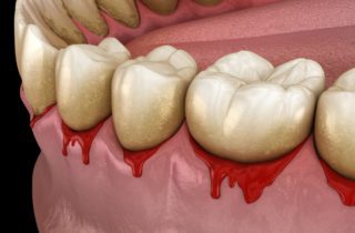 3D image of bleeding gums gum disease dentists in Strongsville Ohio