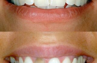 Before and after tooth bonding cosmetic dental procedure dentist in Strongsville Ohio