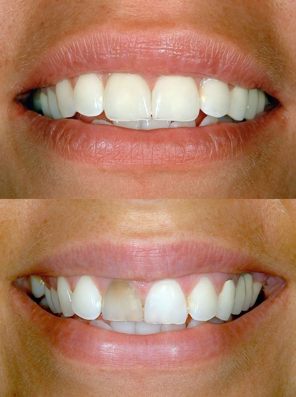 Before and after tooth bonding cosmetic dental procedure dentist in Strongsville Ohio