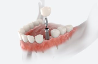 Understanding the dental implant process can help ease any anxiety you may feel so you can get the treatment you need.