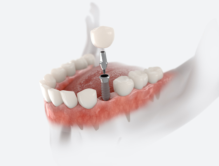 Understanding the dental implant process can help ease any anxiety you may feel so you can get the treatment you need.